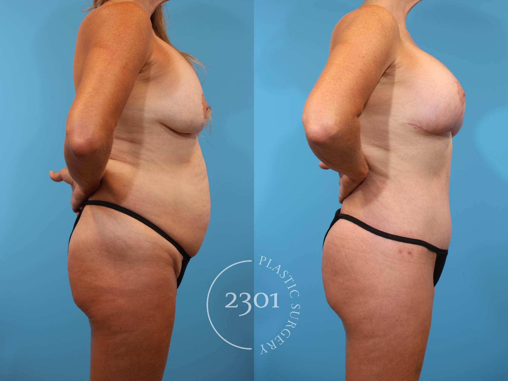 Before & After Mommy Makeover Case 910 Right Side View in Fort Worth, Plano, & Frisco, Texas