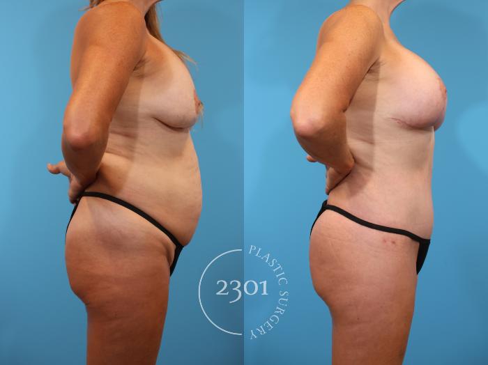 Before & After Mommy Makeover Case 910 Right Side View in Fort Worth, Plano, & Frisco, Texas