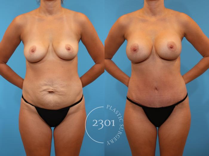 Before & After Mommy Makeover Case 921 Front View in Fort Worth, Plano, & Frisco, Texas