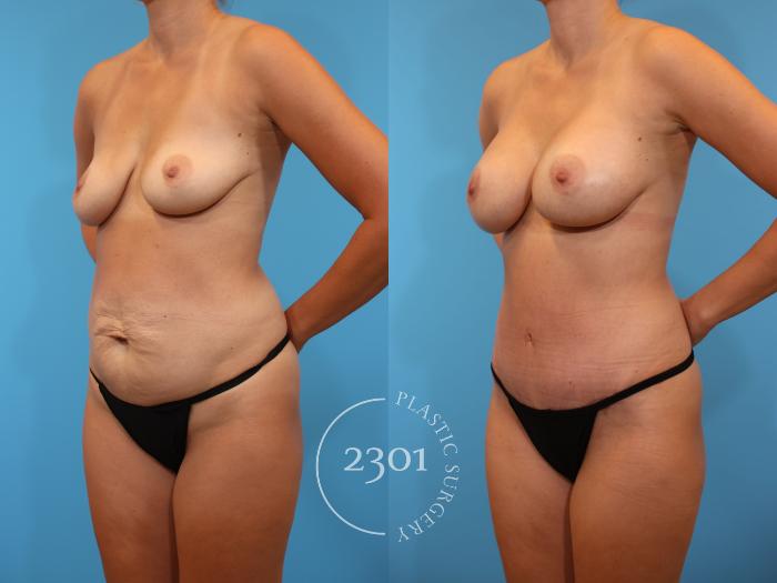 Before & After Mommy Makeover Case 921 Left Oblique View in Fort Worth, Plano, & Frisco, Texas