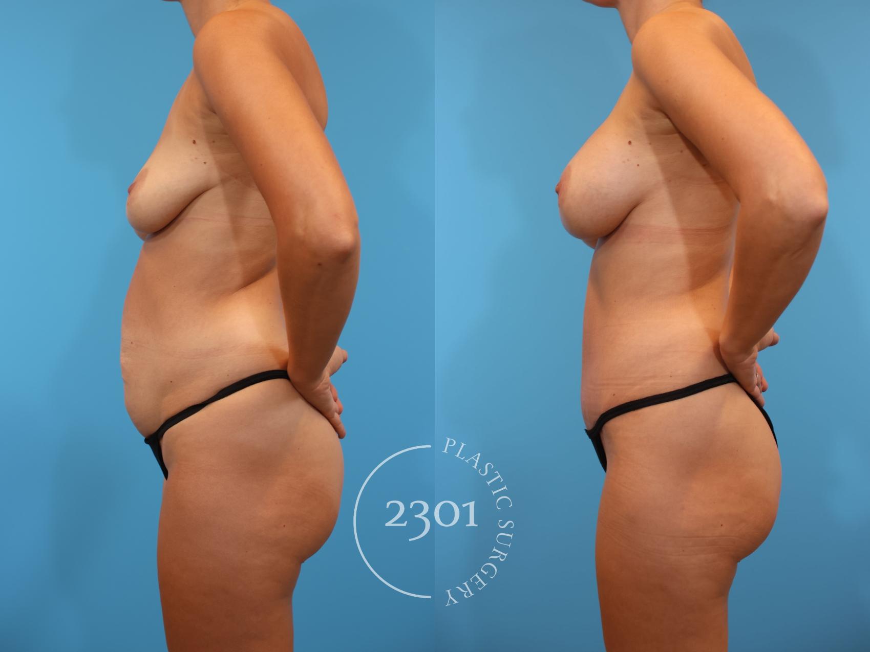 Before & After Mommy Makeover Case 921 Left Side View in Fort Worth, Plano, & Frisco, Texas