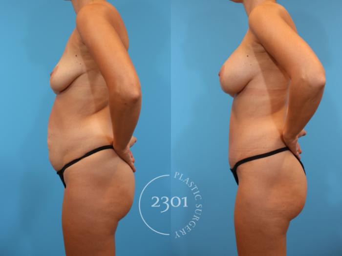 Before & After Mommy Makeover Case 921 Left Side View in Fort Worth, Plano, & Frisco, Texas