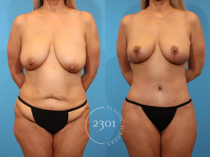 Before & After Mommy Makeover Case 937 Front View in Fort Worth, Plano, & Frisco, Texas