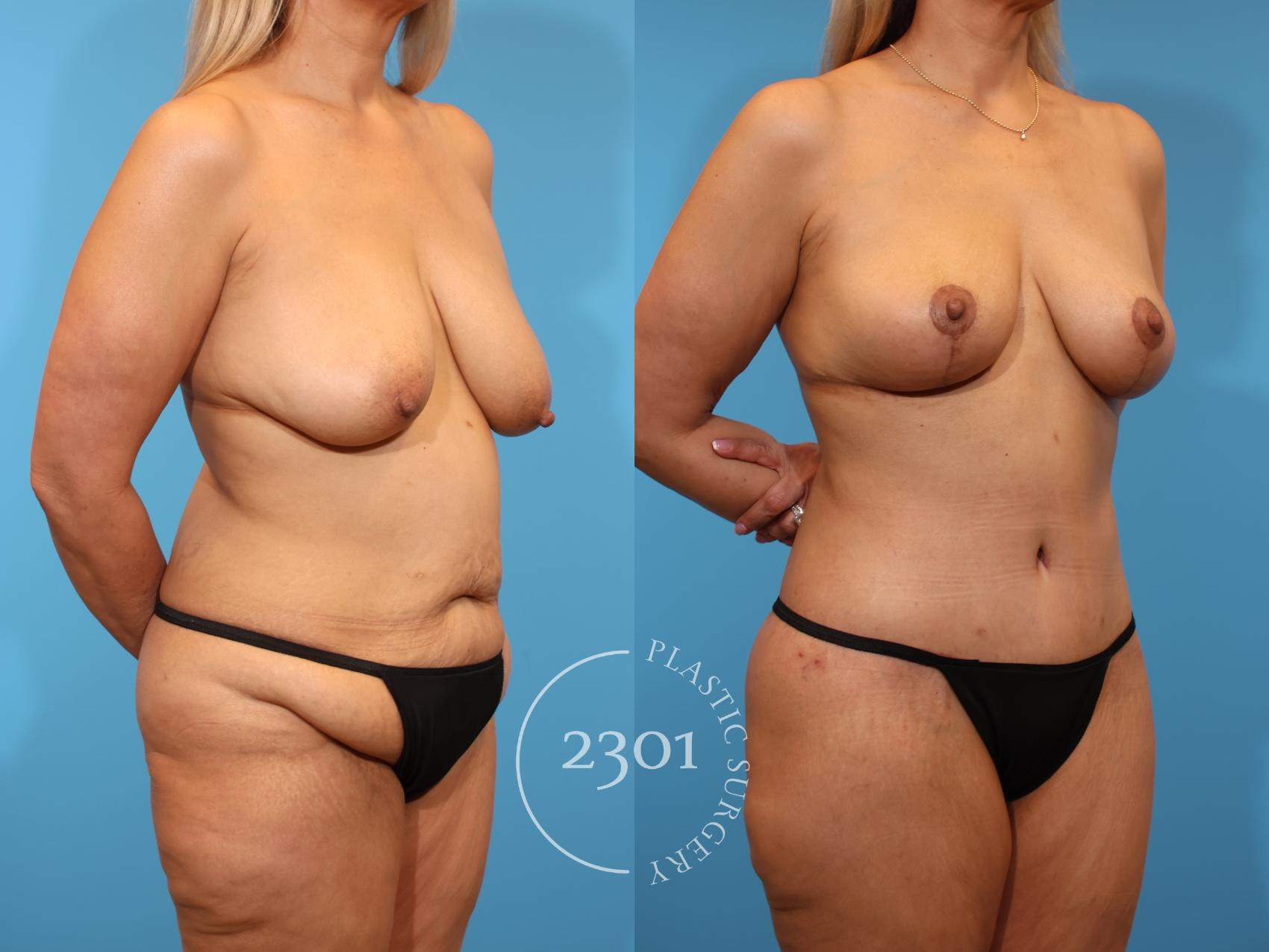 Before & After Mommy Makeover Case 937 Right Oblique View in Fort Worth, Plano, & Frisco, Texas