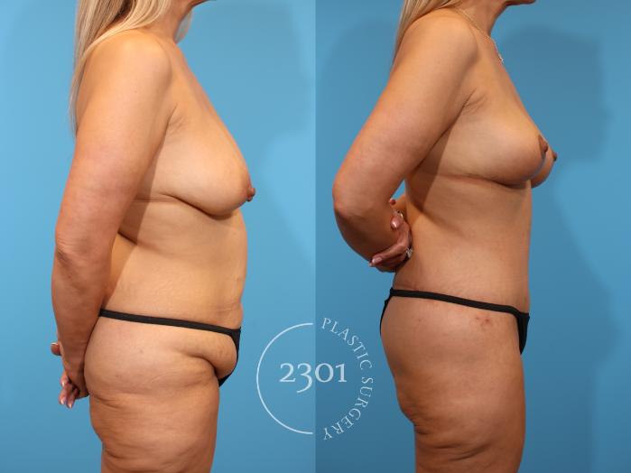 Before & After Mommy Makeover Case 937 Right Side View in Fort Worth, Plano, & Frisco, Texas