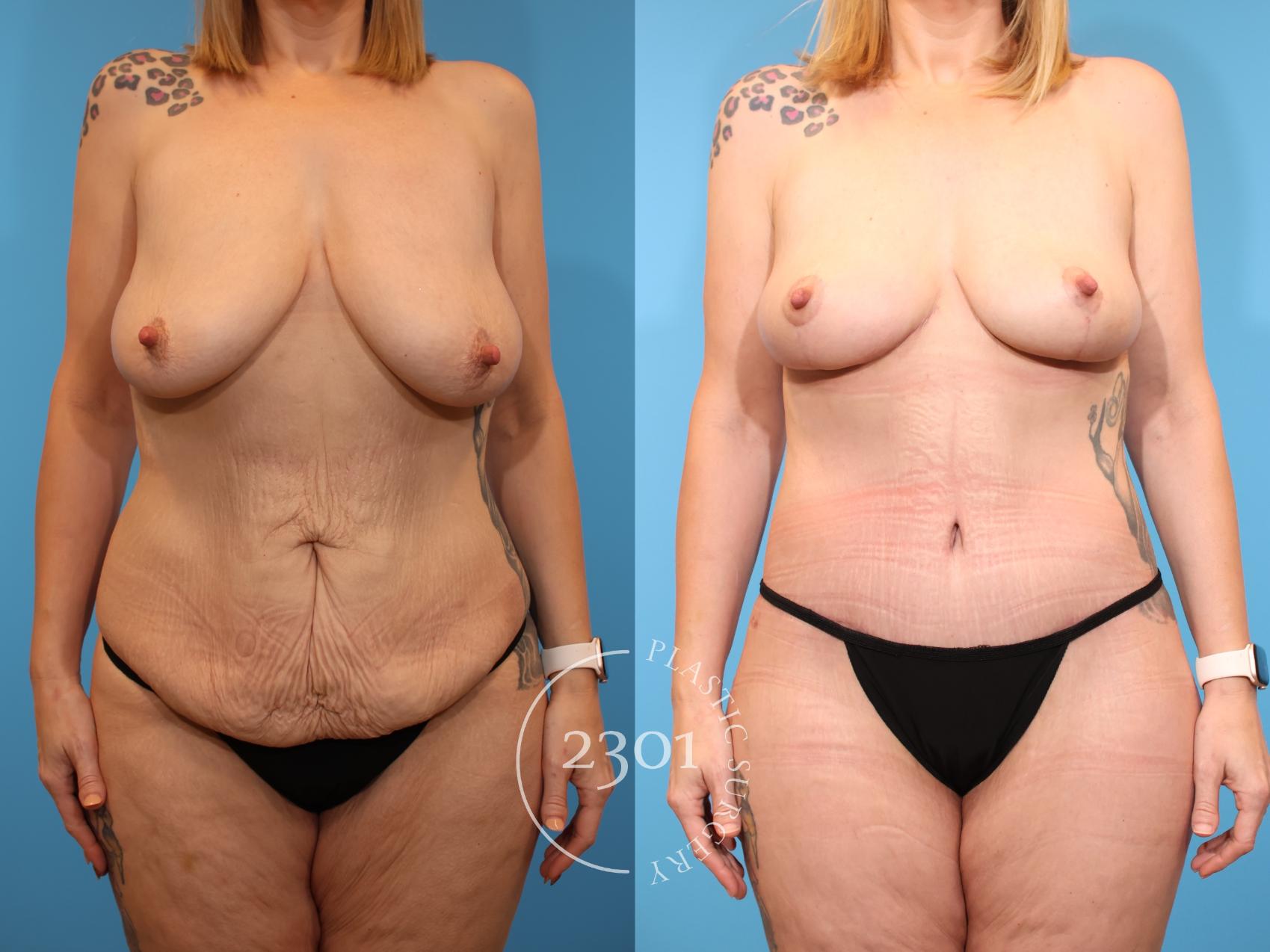 Before & After Post-Bariatric Plastic Surgery Case 939 Front View in Fort Worth, Plano, & Frisco, Texas