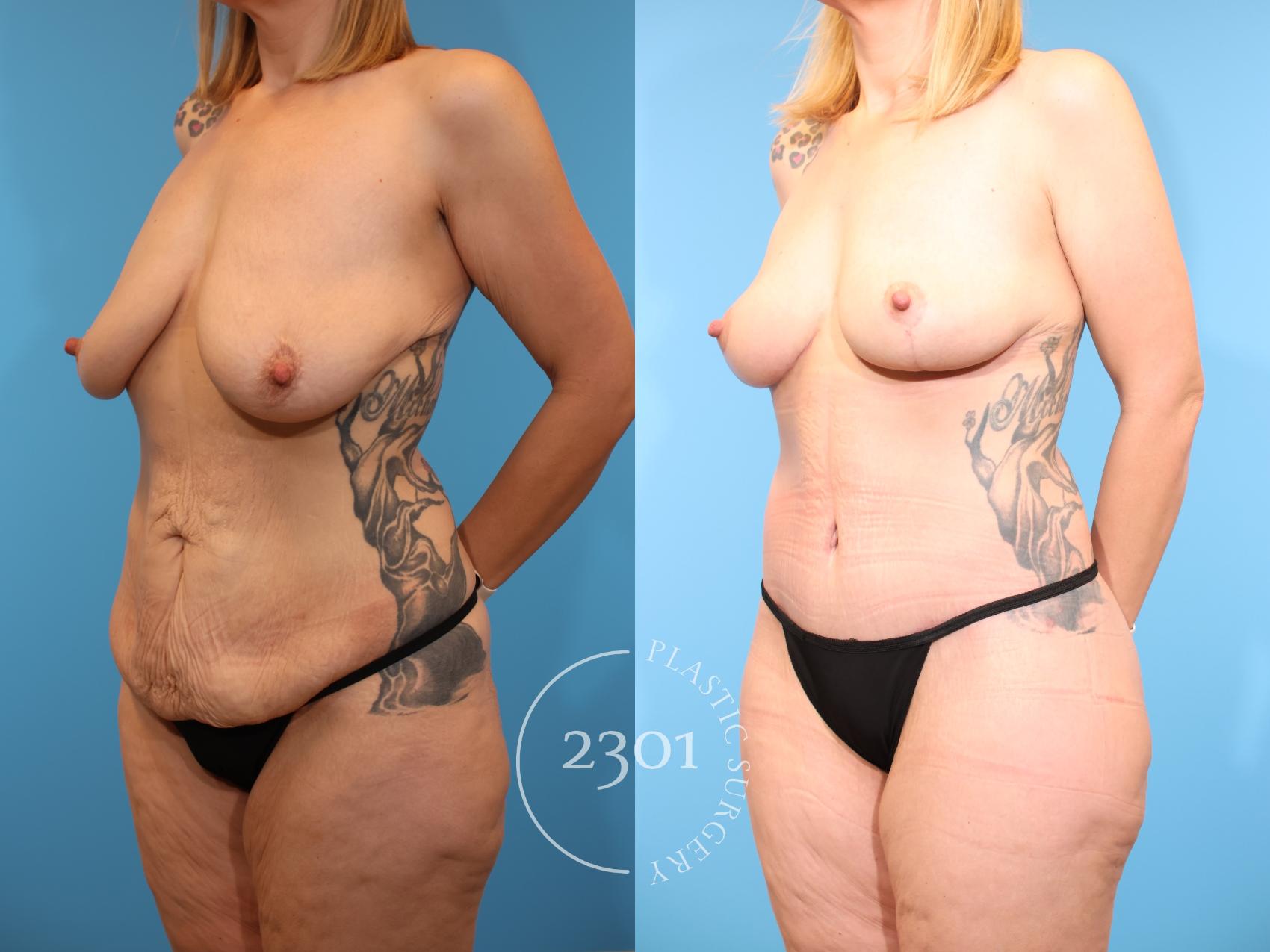Before & After Post-Bariatric Plastic Surgery Case 939 Left Oblique View in Fort Worth, Plano, & Frisco, Texas