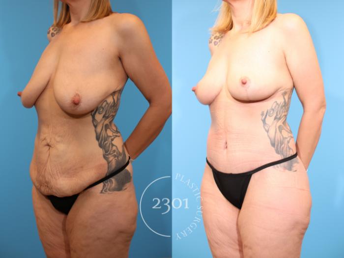 Before & After Post-Bariatric Plastic Surgery Case 939 Left Oblique View in Fort Worth, Plano, & Frisco, Texas