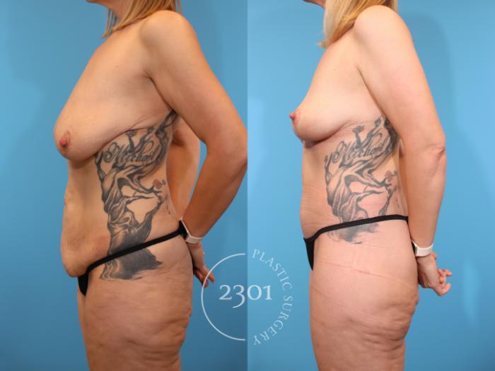 Before & After Post-Bariatric Plastic Surgery Case 939 Left Side View in Fort Worth, Plano, & Frisco, Texas