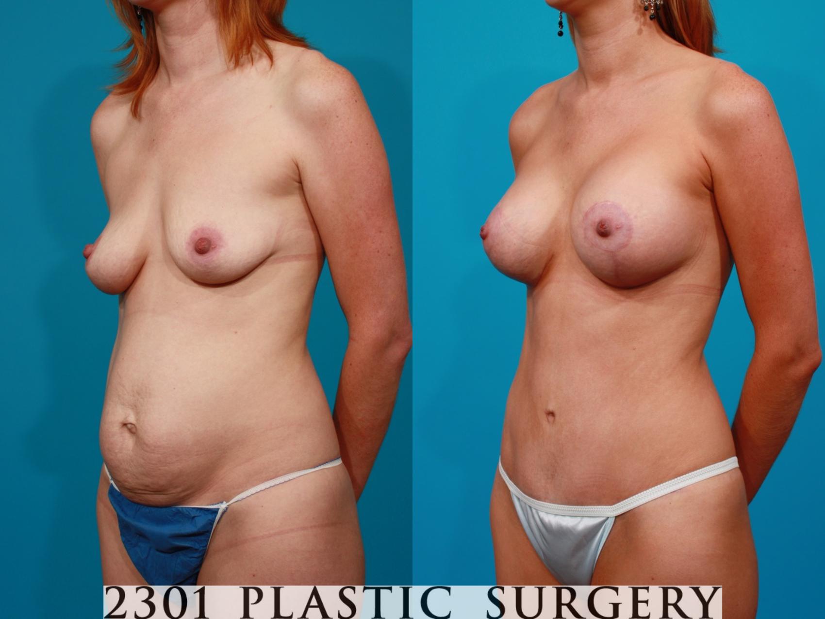 Before & After Mommy Makeover Case 96 View #3 View in Fort Worth & Frisco, Texas