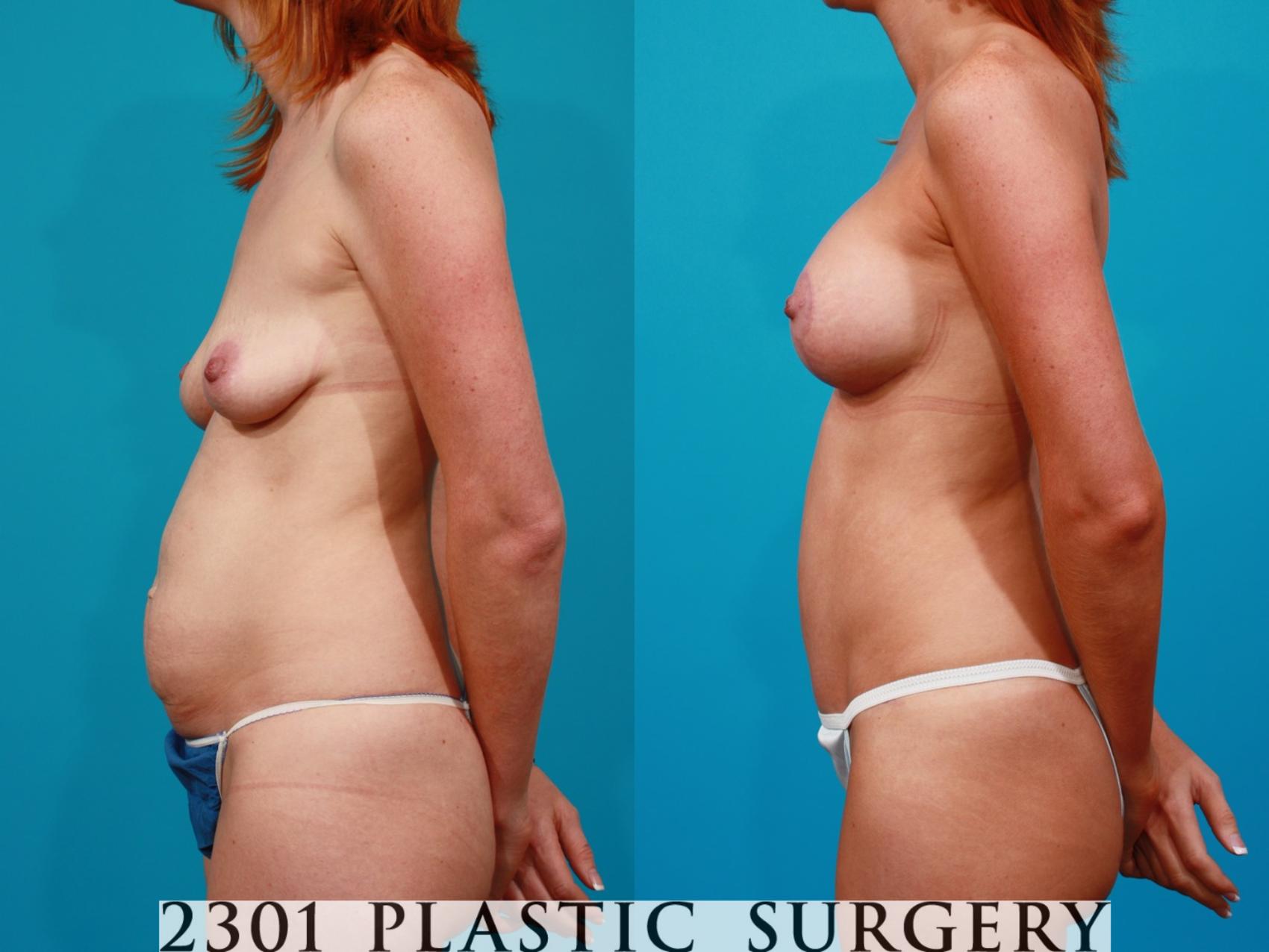 Before & After Tummy Tuck Case 96 View #4 View in Fort Worth & Frisco, Texas