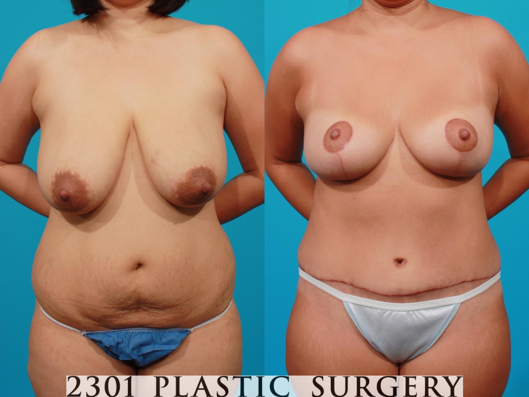 Before & After Breast Reduction Case 97 View #1 View in Fort Worth, Plano, & Frisco, Texas
