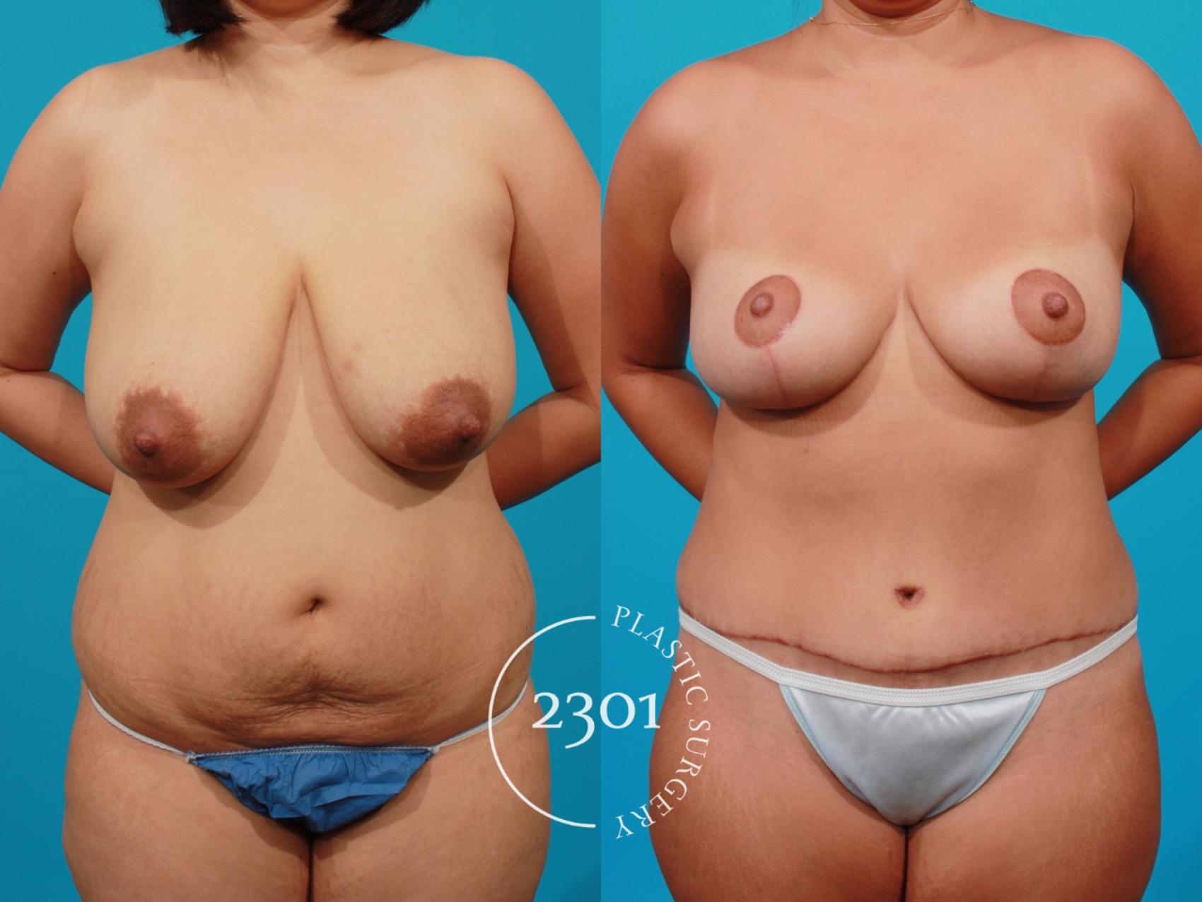 Before & After Breast Reduction Case 97 View #1 View in Fort Worth, Plano, & Frisco, Texas