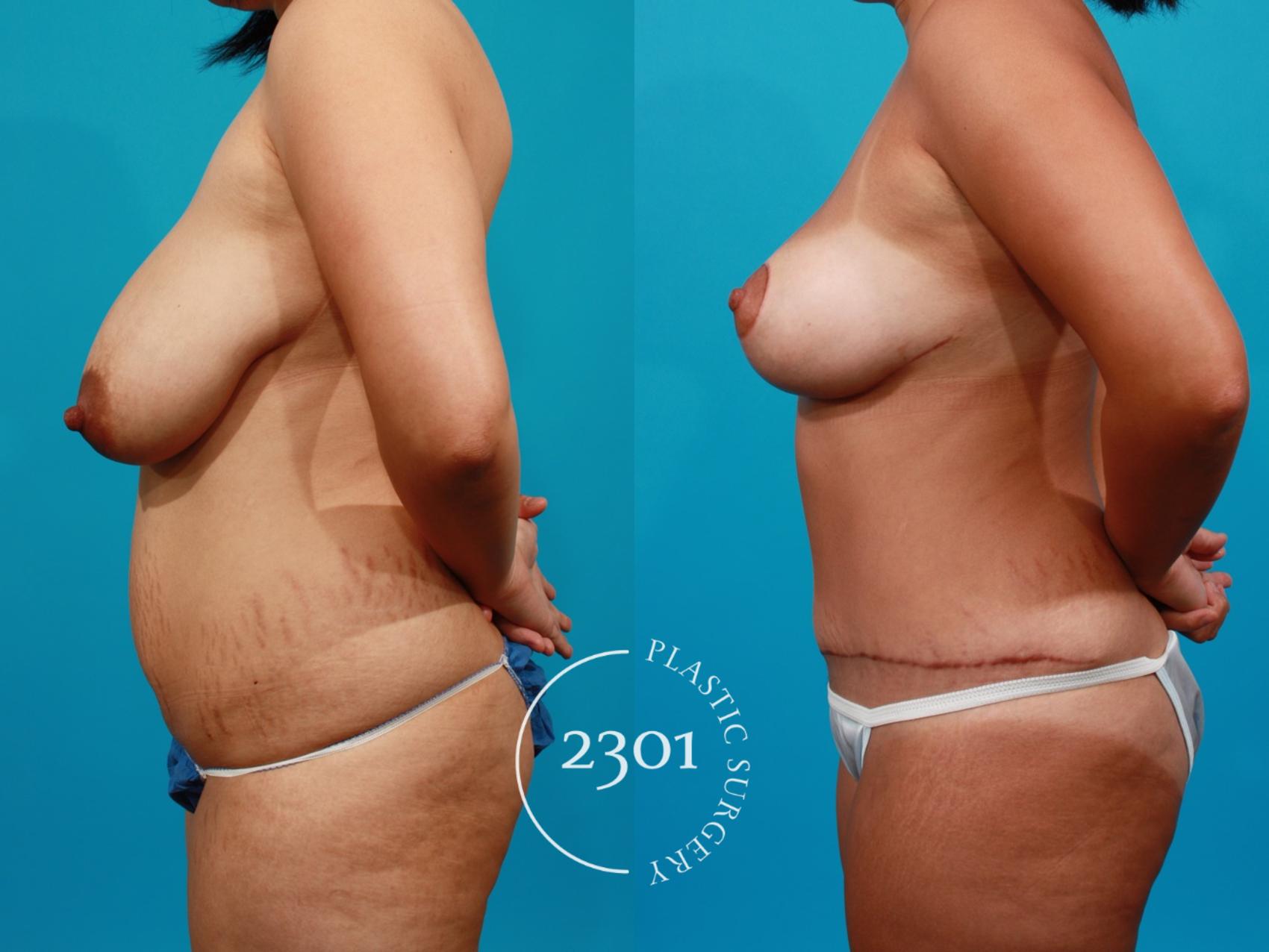 Before & After Mommy Makeover Case 97 View #2 View in Fort Worth, Plano, & Frisco, Texas