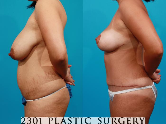 Before & After Breast Reduction Case 97 View #2 View in Fort Worth, Plano, & Frisco, Texas