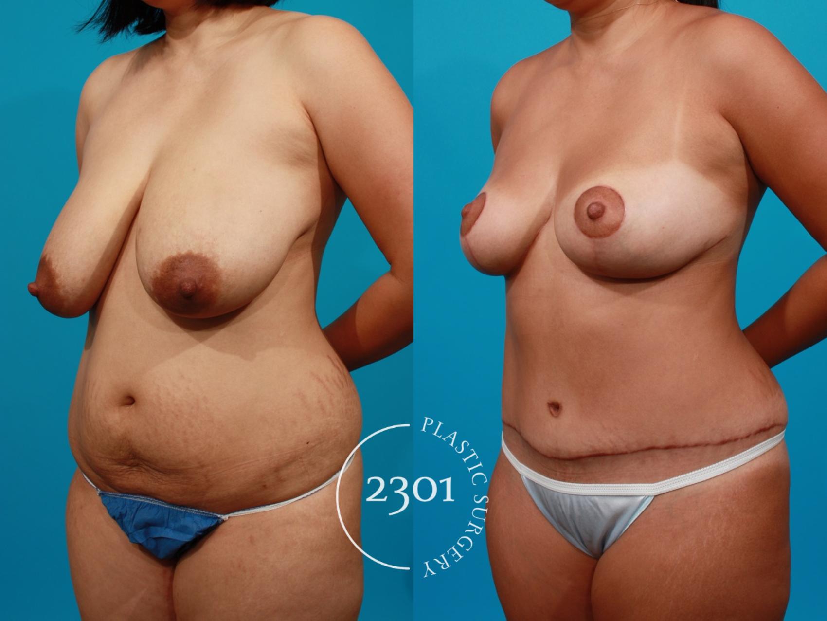 Before & After Mommy Makeover Case 97 View #3 View in Fort Worth, Plano, & Frisco, Texas