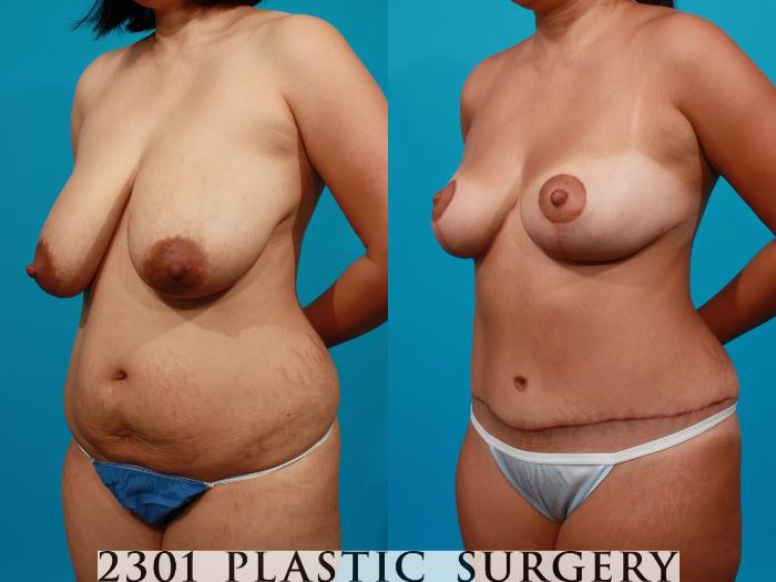 Before & After Breast Reduction Case 97 View #3 View in Fort Worth, Plano, & Frisco, Texas