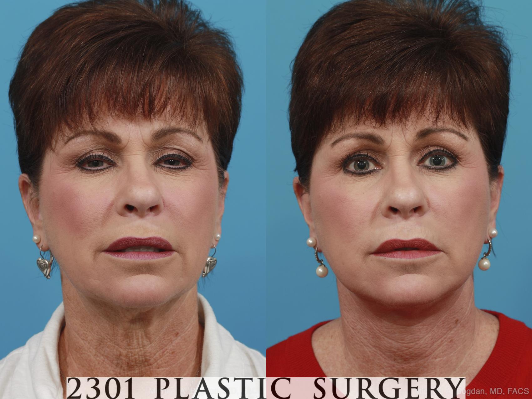 Before & After Neck Lift Case 392 View #1 View in Fort Worth, Plano, & Frisco, Texas