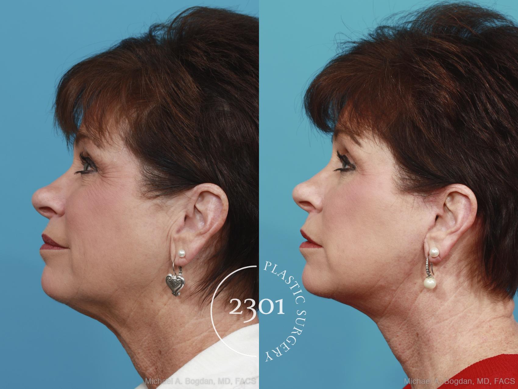 Before & After Neck Lift Case 392 View #2 View in Fort Worth, Plano, & Frisco, Texas