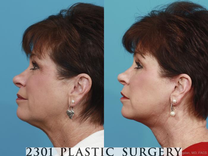 Before & After Neck Lift Case 392 View #2 View in Fort Worth, Plano, & Frisco, Texas