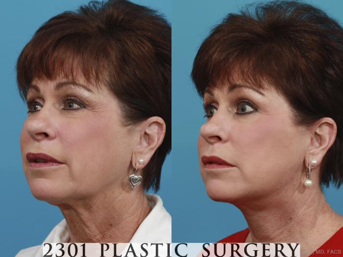 Before & After Neck Lift Case 392 View #3 View in Fort Worth, Plano, & Frisco, Texas