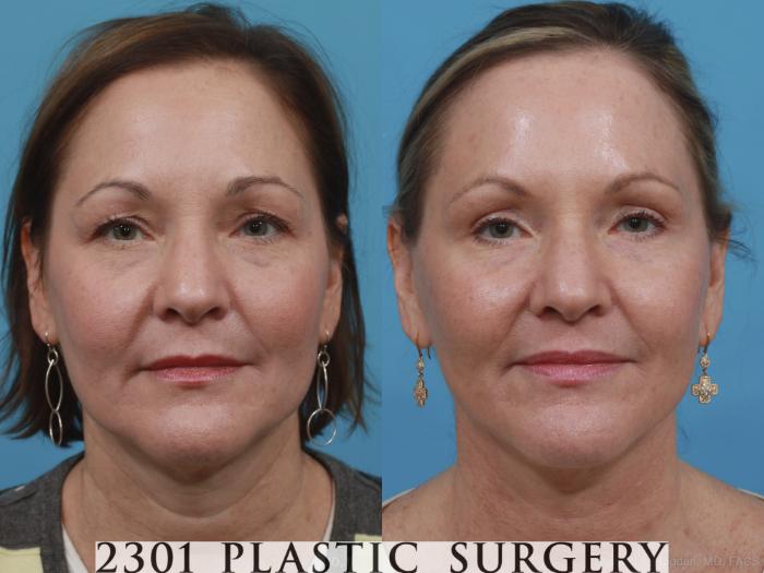 Before & After Neck Lift Case 406 View #1 View in Fort Worth & Frisco, Texas