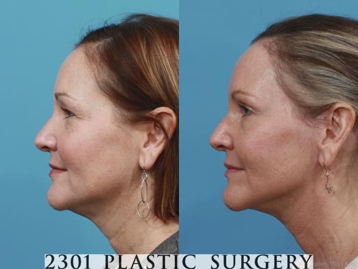 Before & After Neck Lift Case 406 View #2 View in Fort Worth, Plano, & Frisco, Texas