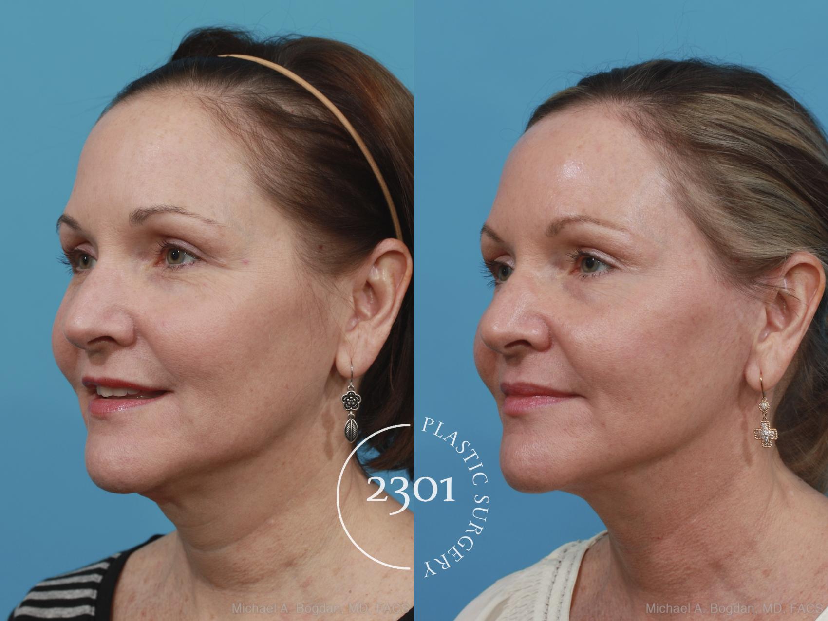 Before & After Neck Lift Case 406 View #3 View in Fort Worth, Plano, & Frisco, Texas