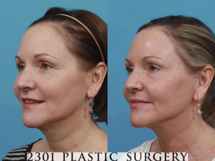 Before & After Neck Lift Case 406 View #3 View in Fort Worth, Plano, & Frisco, Texas