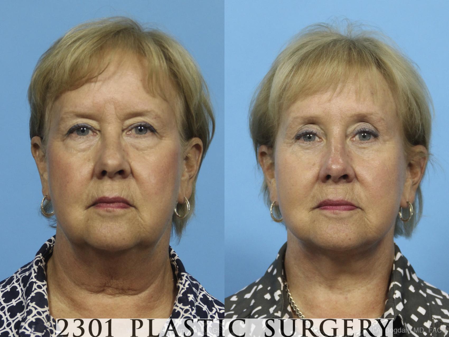 Before & After Neck Lift Case 423 View #1 View in Fort Worth & Frisco, Texas