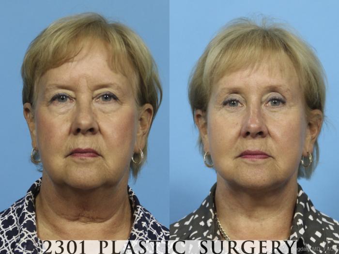 Before & After Neck Lift Case 423 View #1 View in Fort Worth, Plano, & Frisco, Texas