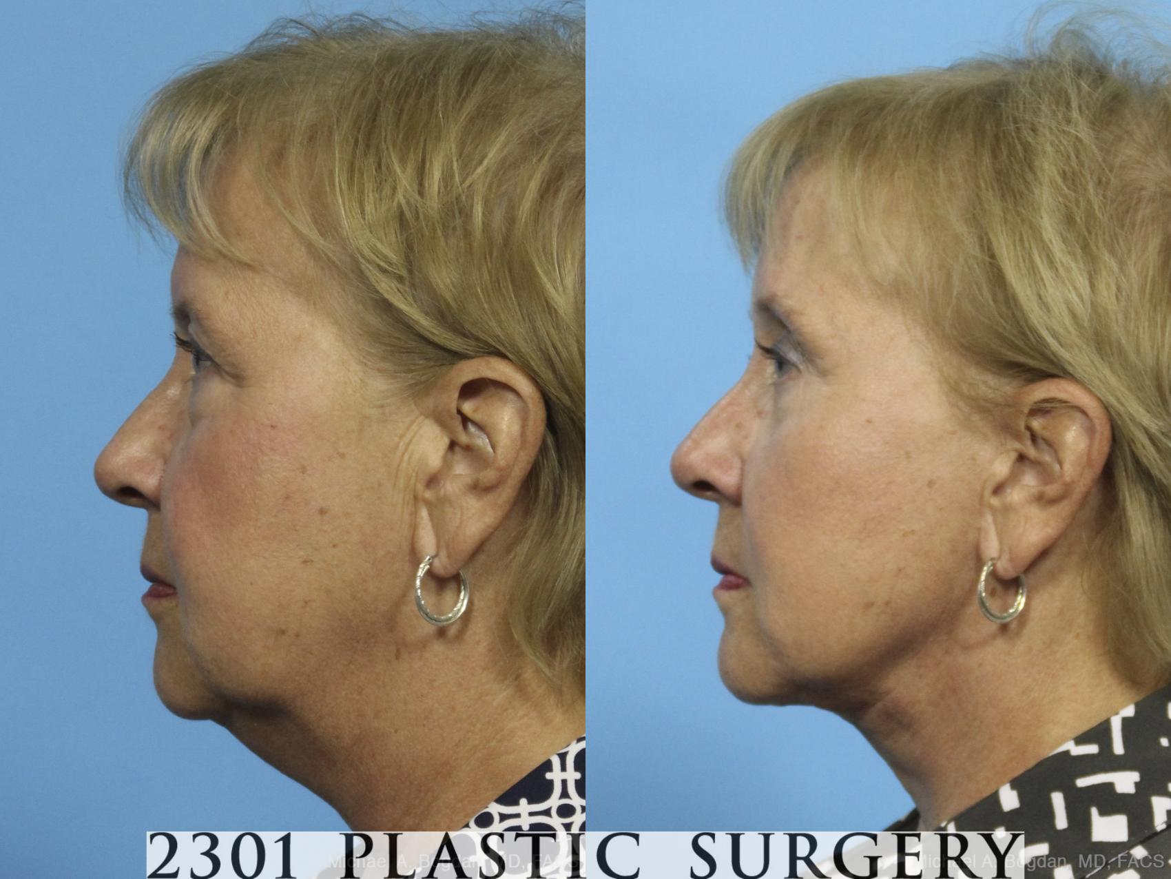 Before & After Neck Lift Case 423 View #2 View in Fort Worth & Frisco, Texas
