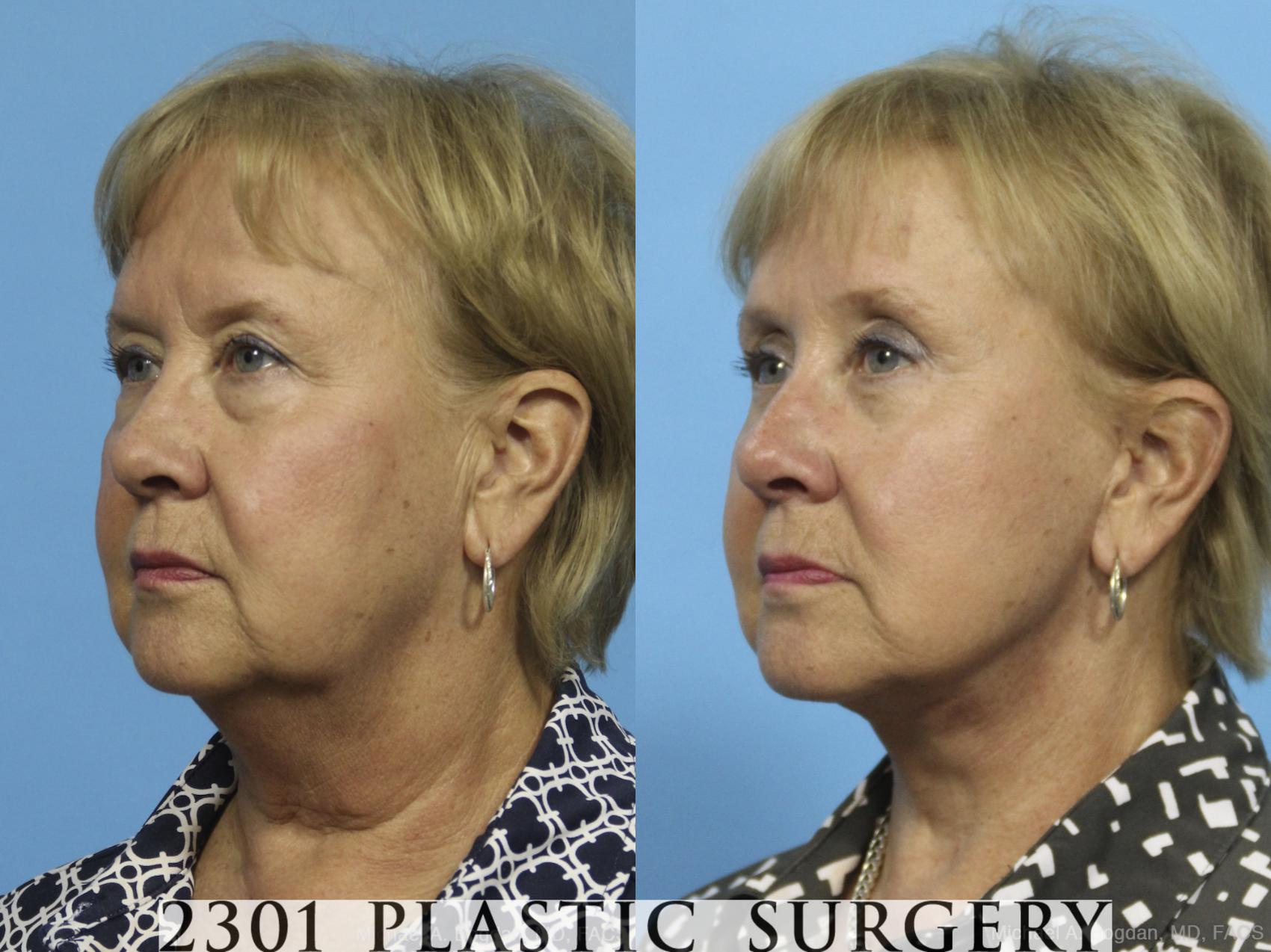 Before & After Neck Lift Case 423 View #3 View in Fort Worth & Frisco, Texas