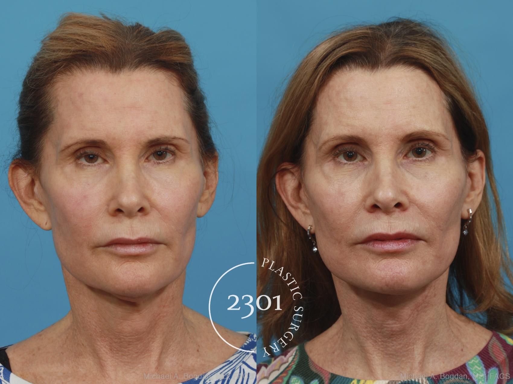 Before & After Neck Lift Case 431 View #1 View in Fort Worth, Plano, & Frisco, Texas
