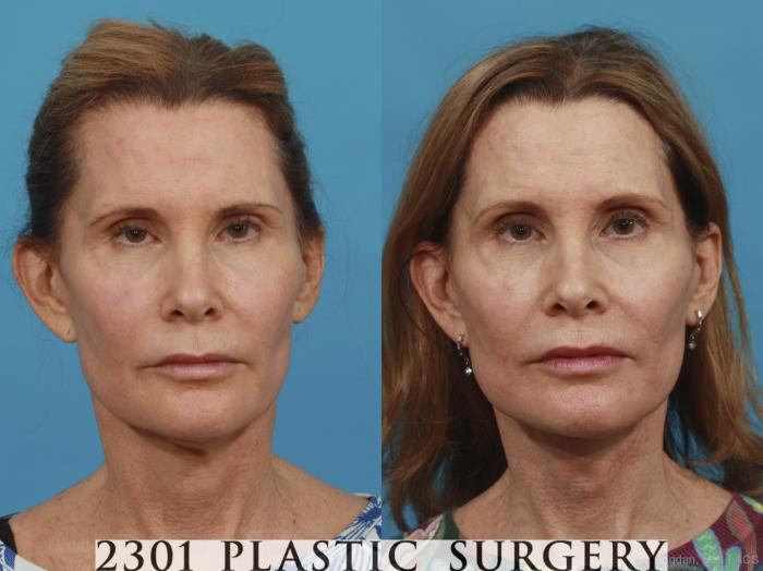 Before & After Neck Lift Case 431 View #1 View in Fort Worth, Plano, & Frisco, Texas