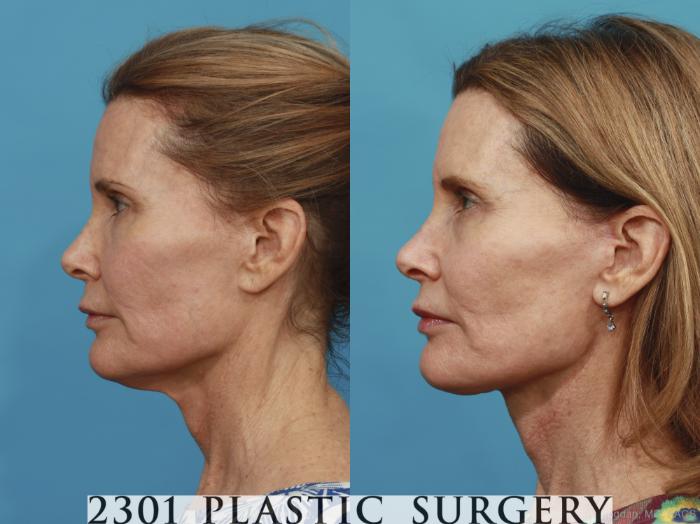 Before & After Neck Lift Case 431 View #2 View in Fort Worth, Plano, & Frisco, Texas
