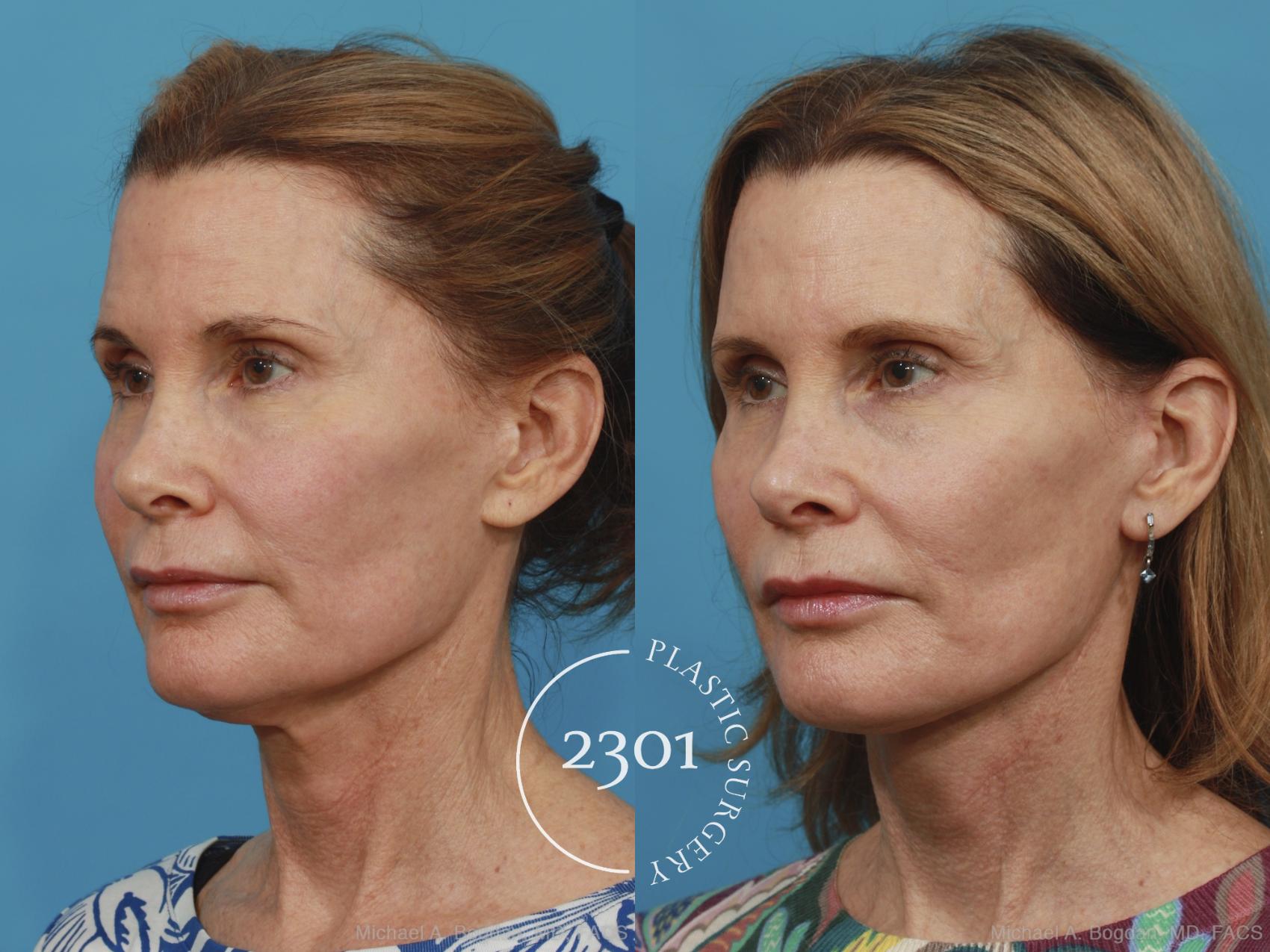 Before & After Neck Lift Case 431 View #3 View in Fort Worth, Plano, & Frisco, Texas