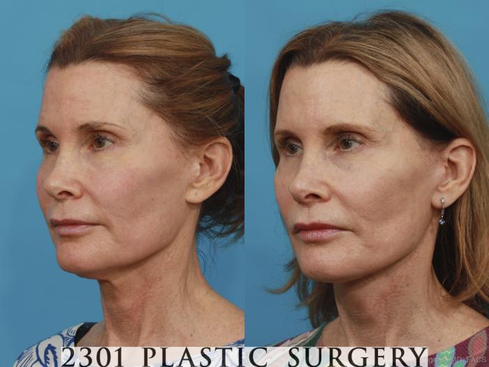 Before & After Neck Lift Case 431 View #3 View in Fort Worth, Plano, & Frisco, Texas