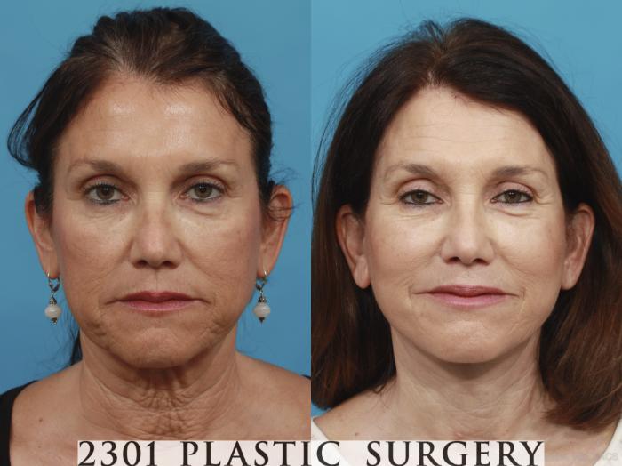 Before & After Neck Lift Case 432 View #1 View in Fort Worth, Plano, & Frisco, Texas