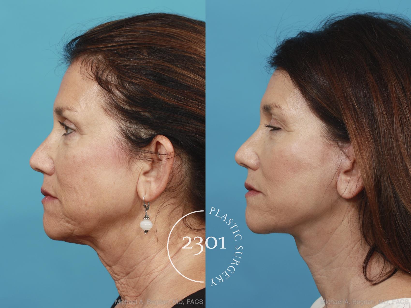Before & After Neck Lift Case 432 View #2 View in Fort Worth, Plano, & Frisco, Texas