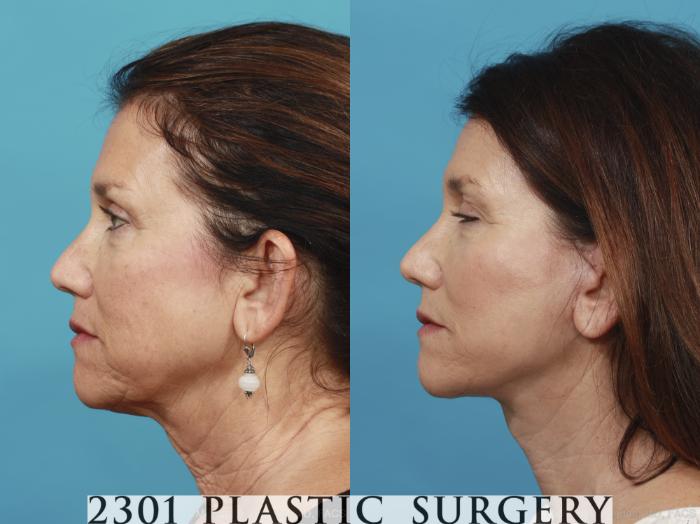 Before & After Neck Lift Case 432 View #2 View in Fort Worth, Plano, & Frisco, Texas
