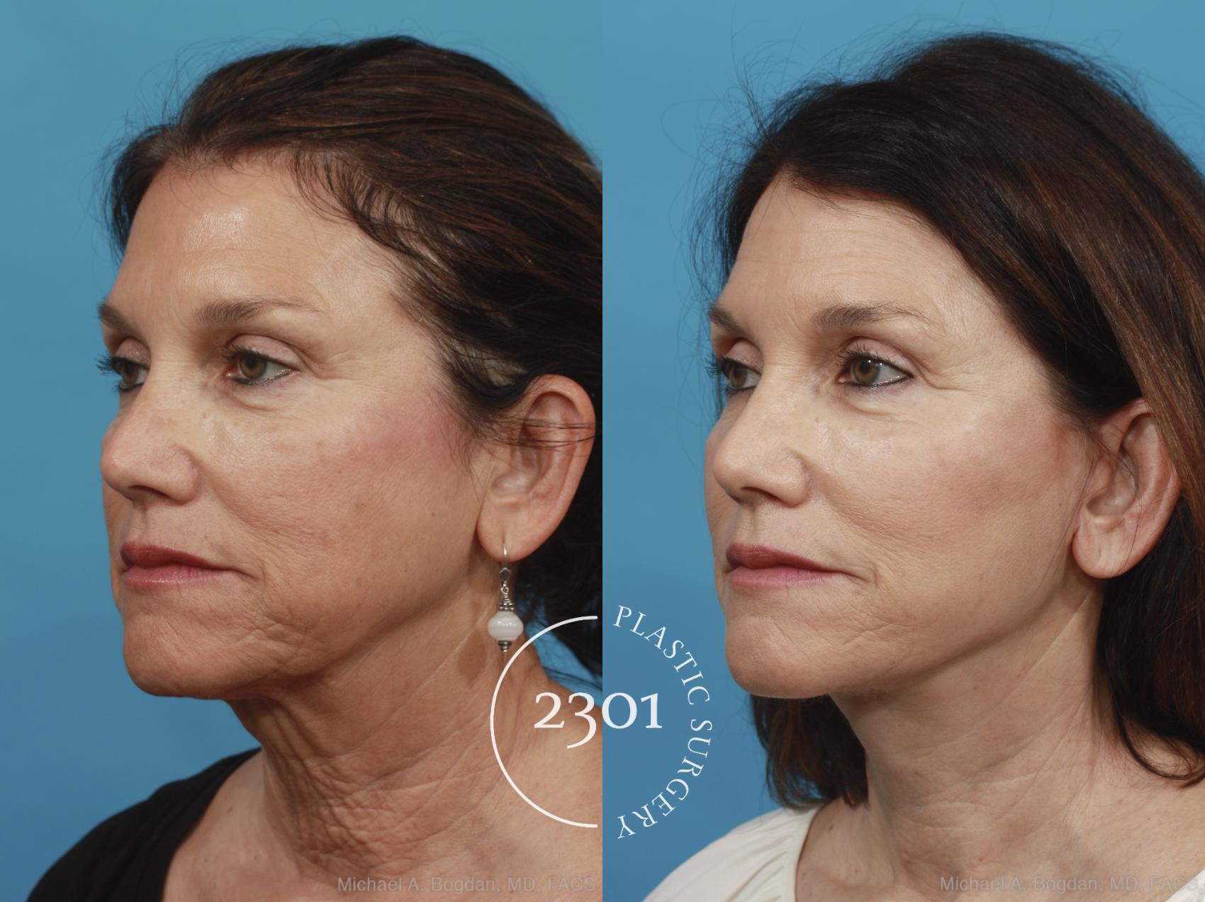 Before & After Neck Lift Case 432 View #3 View in Fort Worth, Plano, & Frisco, Texas