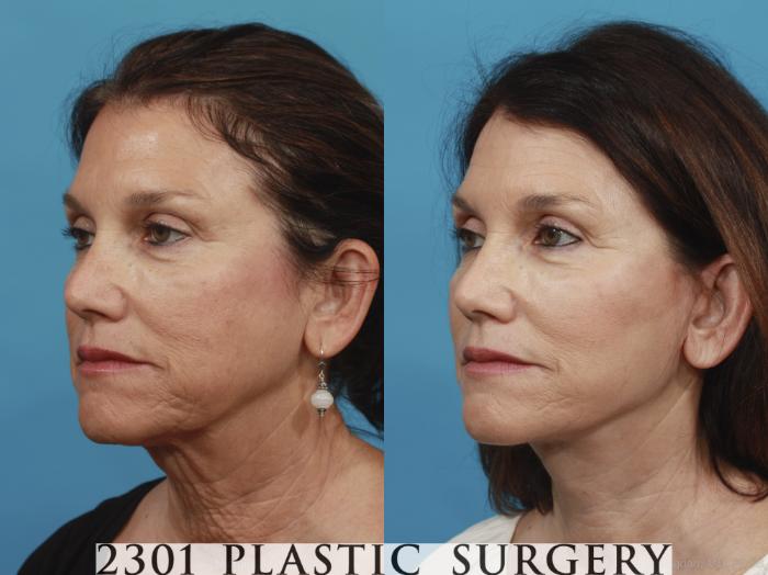 Before & After Neck Lift Case 432 View #3 View in Fort Worth, Plano, & Frisco, Texas