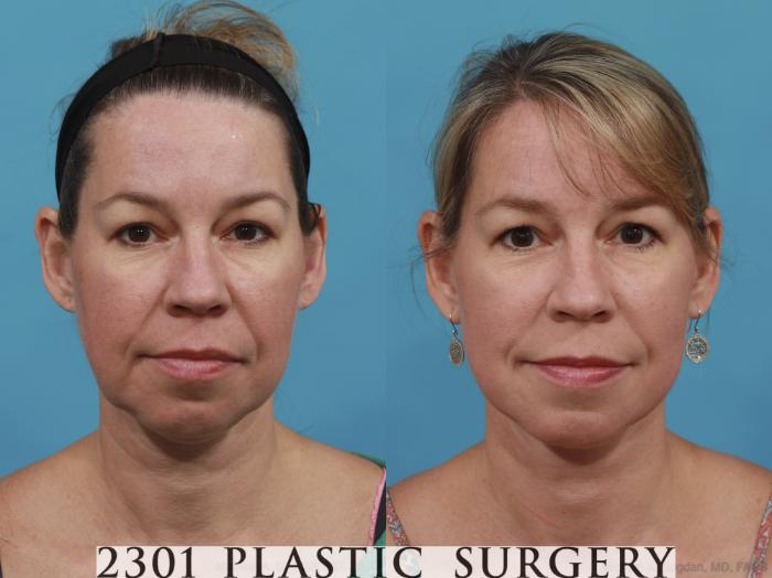 Before & After Neck Lift Case 469 View #1 View in Fort Worth, Plano, & Frisco, Texas