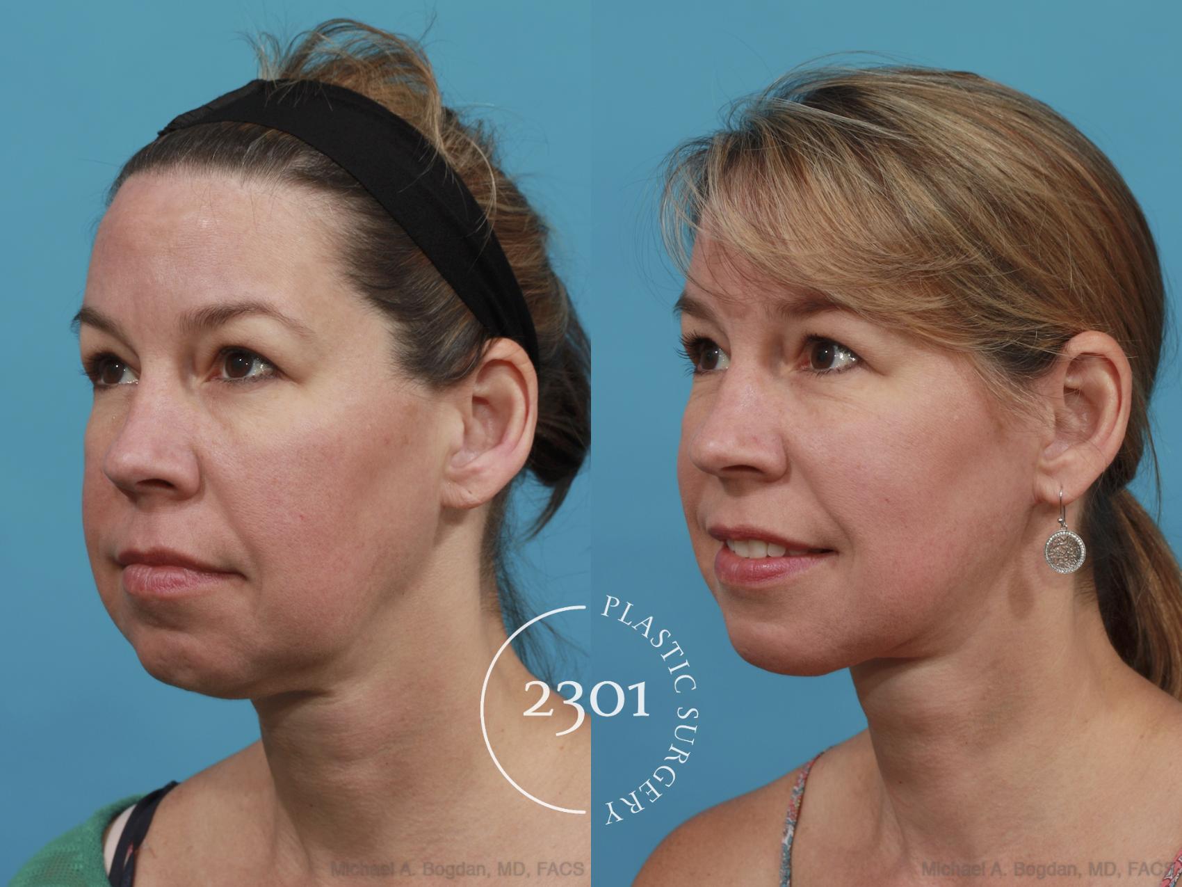 Before & After Neck Lift Case 469 View #2 View in Fort Worth, Plano, & Frisco, Texas