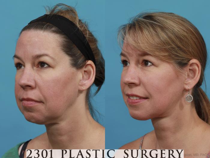Before & After Neck Lift Case 469 View #2 View in Fort Worth, Plano, & Frisco, Texas