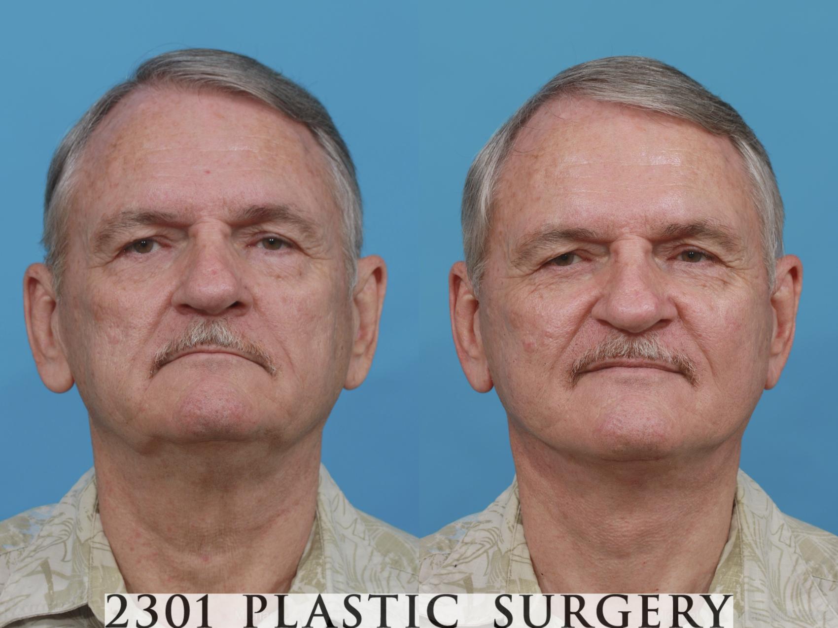 Before & After Neck Lift Case 480 View #1 View in Fort Worth & Frisco, Texas