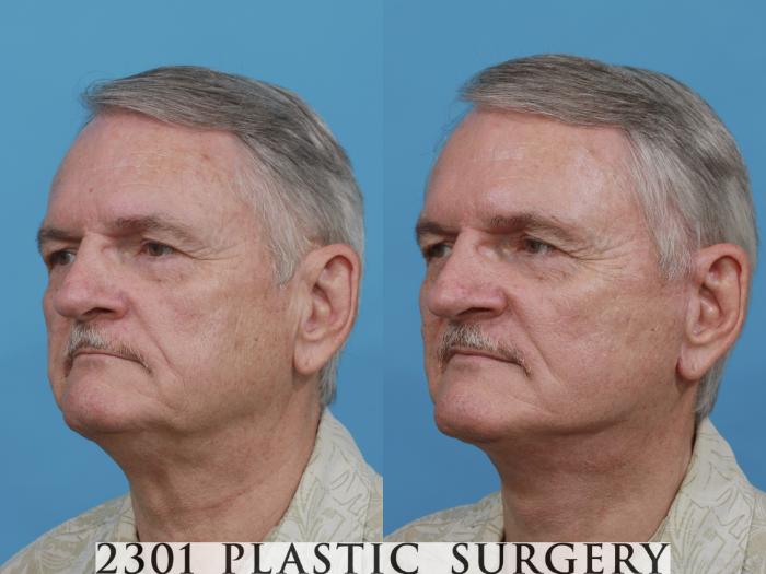 Before & After Neck Lift Case 480 View #2 View in Fort Worth, Plano, & Frisco, Texas