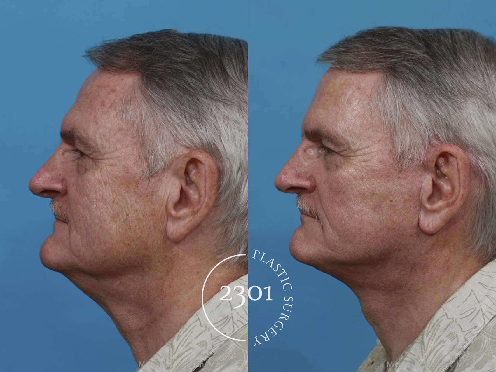 Before & After Neck Lift Case 480 View #3 View in Fort Worth, Plano, & Frisco, Texas