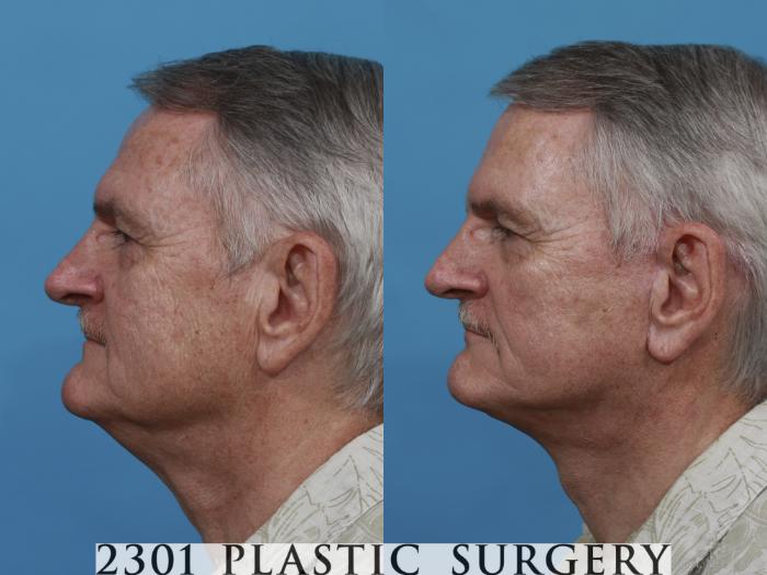 Before & After Neck Lift Case 480 View #3 View in Fort Worth, Plano, & Frisco, Texas